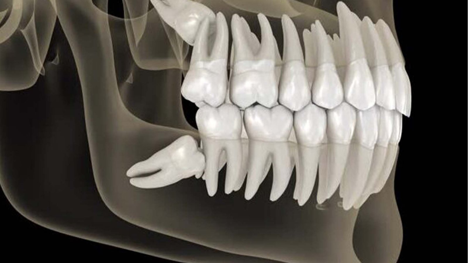 Wisdom Teeth